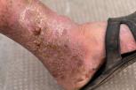 Cara Menghilangkan Bekas Koreng di Kaki yang Sudah Lama